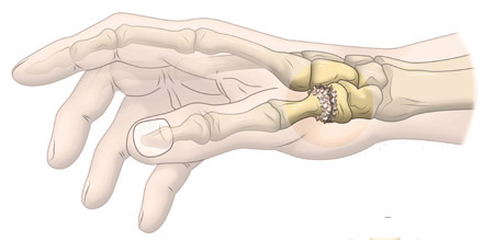 donde se produce la rizartrosis del pulgar: entre el primer metacarpiano y el hueso trapecio de la mano
