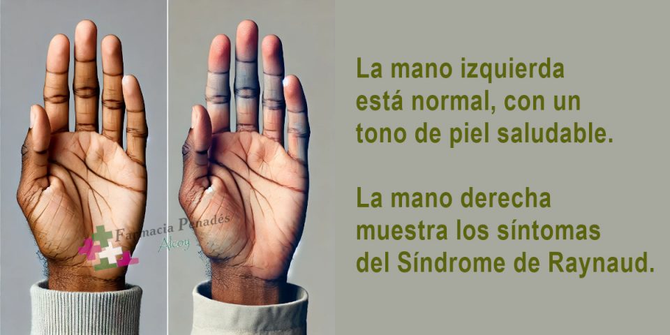 Síndrome Raynaud Diferencia mano normal ( derecha) de mano con menos flujo sanguíneo y color más pálido (mano izquierda).