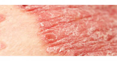 Psoriasis y picor. En Farmacia Penades Alcoy te hacemos un protocolo personalizado para controlarla y que tengas menos brotes